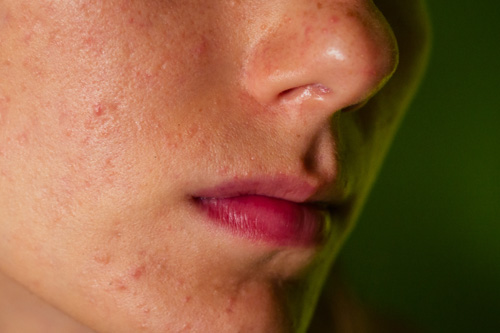 post-acne, scars and red festering pimples on the face of a youn
